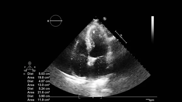Bild Hjärtat Gråskala Transesofagalt Ultraljud — Stockfoto