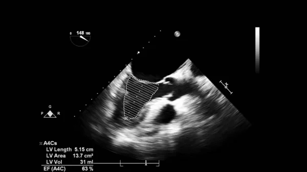 Image of the heart in gray-scale mode during transesophageal ultrasound.