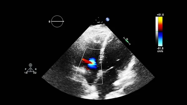 Imagem Coração Durante Ultrassom Transesofágico Com Modo Doppler — Fotografia de Stock