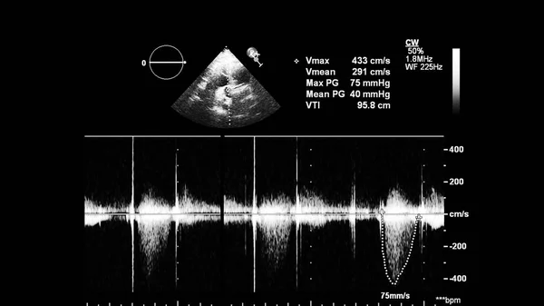 Transesofageal Ultrason Sırasında Kalbin Gri Ölçekli Görüntüsü — Stok fotoğraf