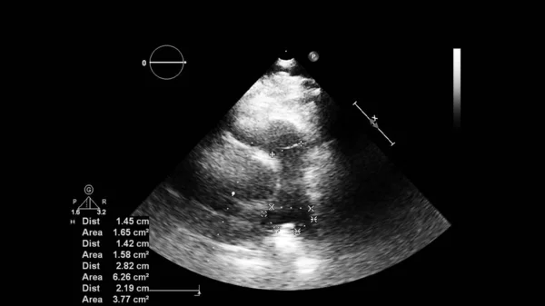 Image Heart Gray Scale Mode Transesophageal Ultrasound — Stock Photo, Image