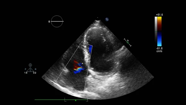 Bild Des Herzens Beim Transesophagealen Ultraschall Mit Doppler Modus — Stockfoto