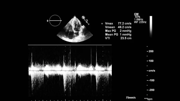 经食管超声下灰度型心脏影像学 — 图库照片