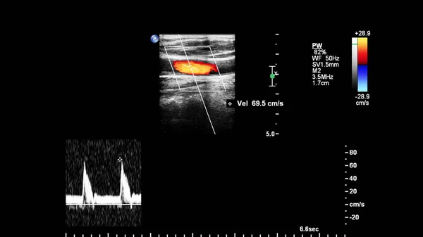 Badanie Ultrasonograficzne Dopplera Fali Impulsowej — Zdjęcie stockowe