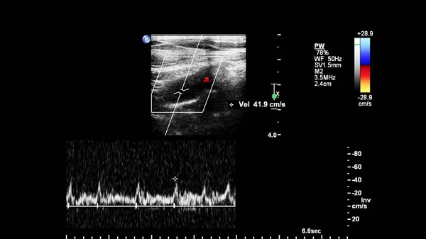 Badanie Ultrasonograficzne Dopplera Fali Impulsowej — Zdjęcie stockowe