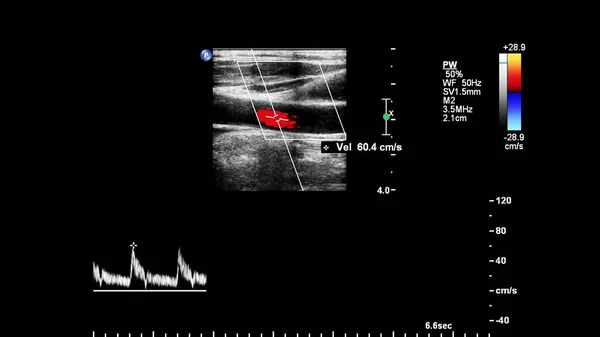 Examen Par Ultrasons Doppler Ondes Pulsées — Photo