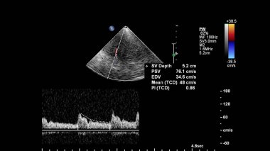 Pulse wave Doppler ultrasound examination of vessels.