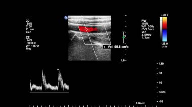 Pulse wave Doppler ultrasound examination of vessels.