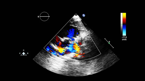 Image Heart Transesophageal Ultrasound Doppler Mode — Stock Photo, Image