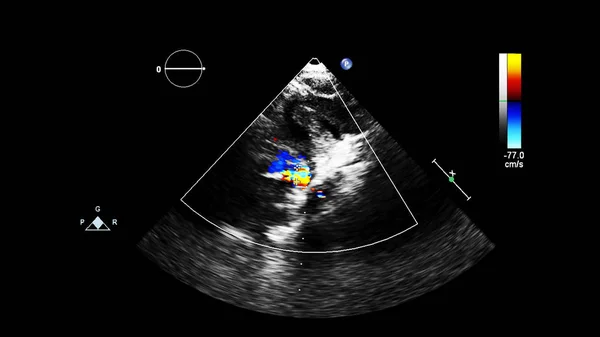 Image Heart Transesophageal Ultrasound Doppler Mode — Stock Photo, Image