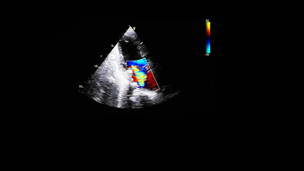 Kuva Sydämestä Transesofageaalisen Ultraäänen Aikana Doppler Tilassa — kuvapankkivalokuva