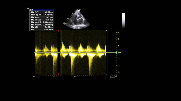 Изображение сердца в сером режиме во время трансофагеального ультразвука.