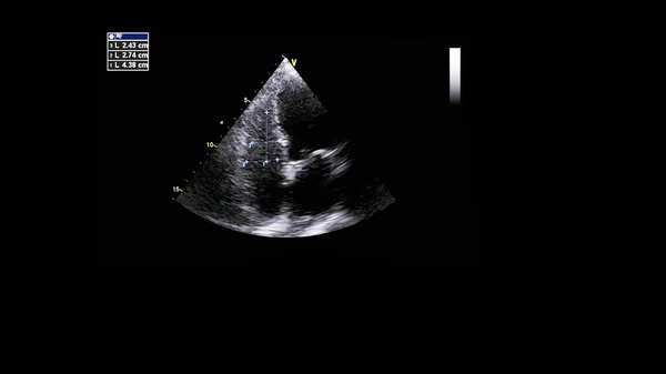 Image of the heart in gray-scale mode during transesophageal ultrasound.