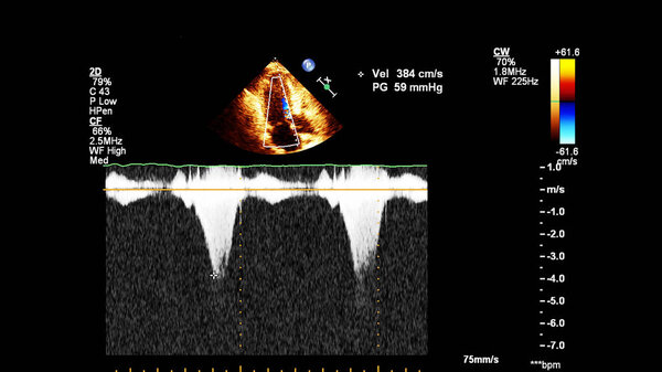 Image of the heart during transesophageal ultrasound with Doppler mode.