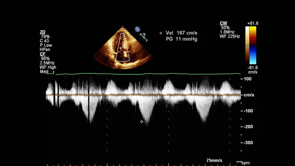 Imagem Coração Durante Ultrassom Transesofágico Com Modo Doppler — Fotografia de Stock