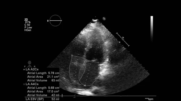 Image Heart Gray Scale Mode Transesophageal Ultrasound — Stock Photo, Image