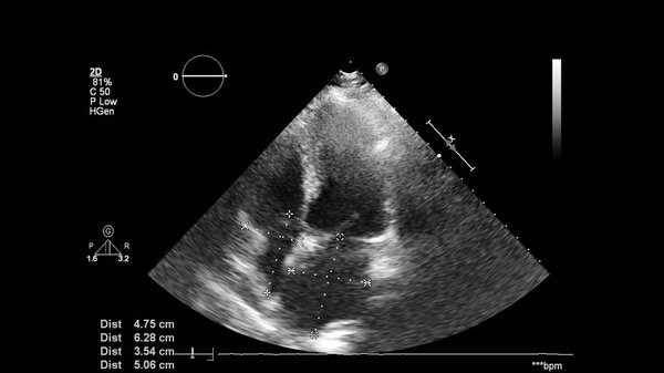 Изображение сердца в сером режиме во время трансофагеального ультразвука.