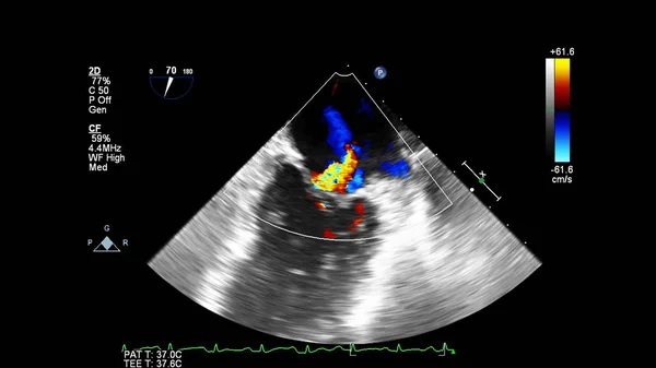 Изображение Сердца Время Трансофагеального Ультразвука Доплеровским Режимом — стоковое фото