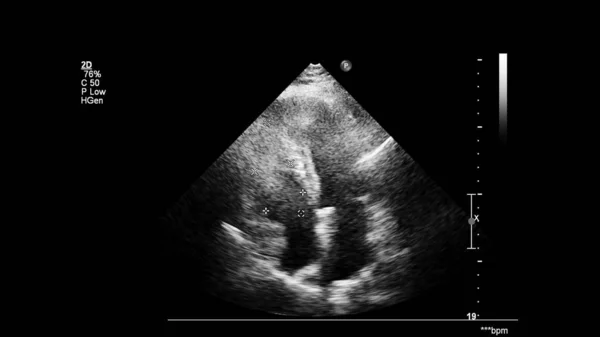 Image Heart Gray Scale Mode Transesophageal Ultrasound — Stock Photo, Image