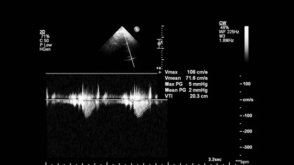 Image Cœur Mode Gris Lors Une Échographie Transœsophagienne — Photo