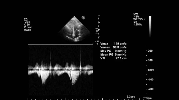 Image Cœur Mode Gris Lors Une Échographie Transœsophagienne — Photo