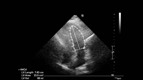 経食道超音波検査時のグレースケールモードで心臓の画像 — ストック写真