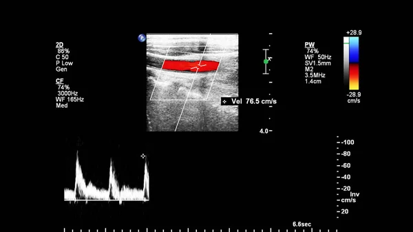 Pulse Wave Doppler Ultrasound Examination Vessels — Stok fotoğraf