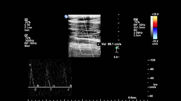 Pulse Wave Doppler Ultrasound Examination Vessels — Stockfoto