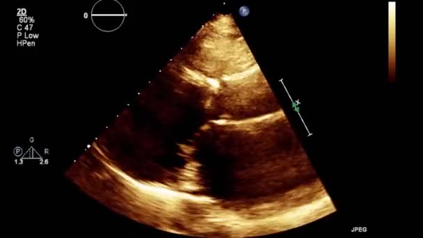 Examen Transesofágico Por Ultrasonido Video Alta Calidad Del Corazón — Vídeo de stock