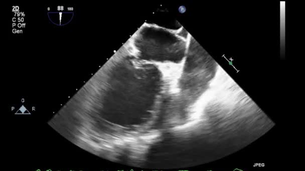Качественное Видео Ультразвуковое Трансофагеальное Обследование Сердца — стоковое видео