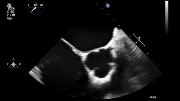 Ecografia Video Alta Qualità Esame Transesofageo Del Cuore — Video Stock