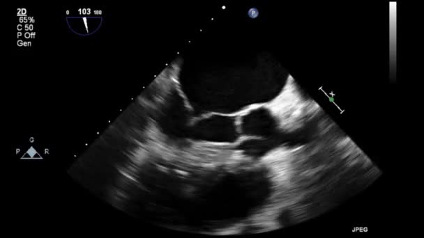 High Quality Video Ultrasound Transesophageal Examination Heart — Stock Video