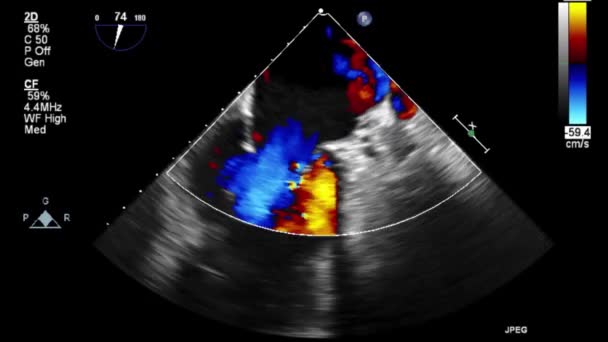 心臓の高品質ビデオ超音波経食道検査 — ストック動画