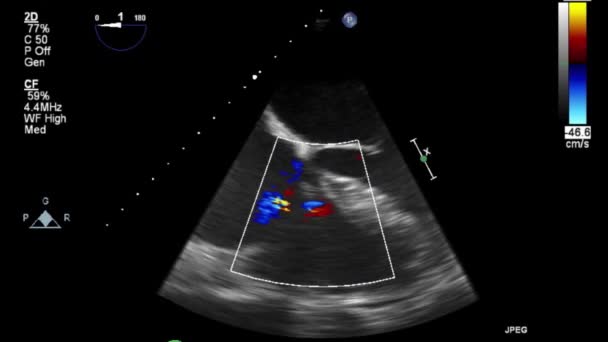 Hoge Kwaliteit Video Echografie Transslokdarmonderzoek Van Het Hart — Stockvideo