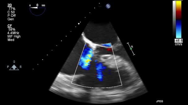 Kalbin Yüksek Kaliteli Ultrason Transsofageal Muayenesi — Stok video