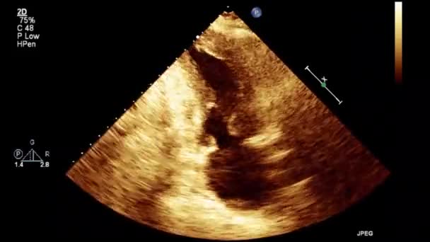 Hoge Kwaliteit Video Echografie Transslokdarmonderzoek Van Het Hart — Stockvideo