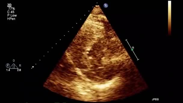 Examen Transesofágico Por Ultrasonido Video Alta Calidad Del Corazón — Vídeo de stock