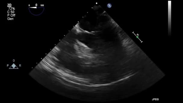 Качественное Видео Ультразвуковое Трансофагеальное Обследование Сердца — стоковое видео