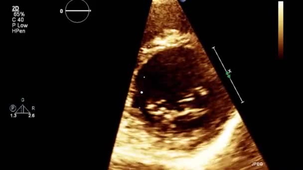 Vídeo Ultra Som Alta Qualidade Exame Transesofágico Coração — Vídeo de Stock