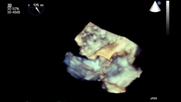 Hochwertige Video Ultraschall Transesophagealuntersuchung Des Herzens — Stockvideo
