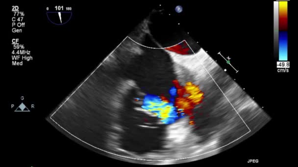 Vídeo Ultra Som Alta Qualidade Exame Transesofágico Coração — Vídeo de Stock