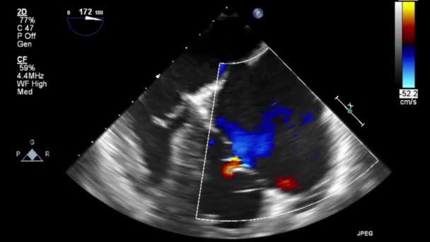Høj Kvalitet Video Ultralyd Transesophageal Undersøgelse Hjertet – Stock-video