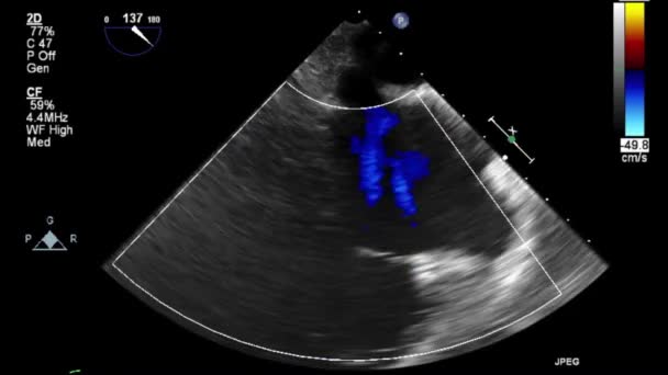 Examen Transesofágico Por Ultrasonido Video Alta Calidad Del Corazón — Vídeos de Stock