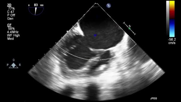 Vysoce Kvalitní Video Ultrazvukové Transesofageální Vyšetření Srdce — Stock video