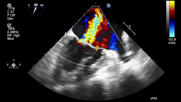 Examen Transesofágico Por Ultrasonido Video Alta Calidad Del Corazón — Vídeos de Stock