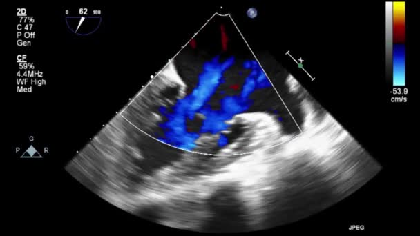 Examen Transesofágico Por Ultrasonido Video Alta Calidad Del Corazón — Vídeos de Stock