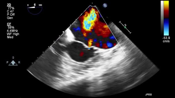 Качественное Видео Ультразвуковое Трансофагеальное Обследование Сердца — стоковое видео