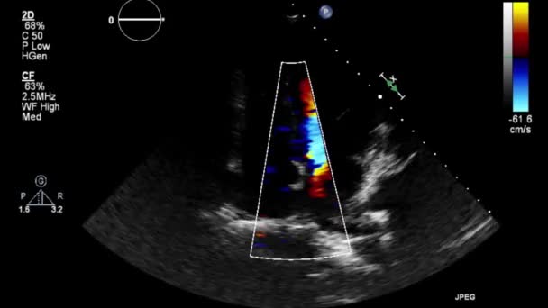 Vysoce Kvalitní Video Ultrazvukové Transesofageální Vyšetření Srdce — Stock video