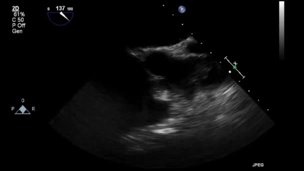 Examen Transesofágico Por Ultrasonido Video Alta Calidad Del Corazón — Vídeos de Stock