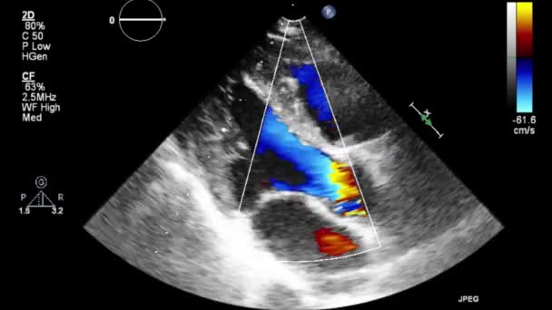 Ecografia Video Alta Qualità Esame Transesofageo Del Cuore — Video Stock